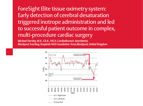 Case Study: Early detection triggered inotrope use during multi-procedure cardiac surgery