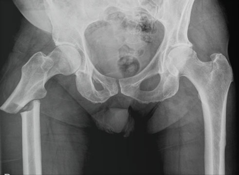 Proximal Femoral Fractures