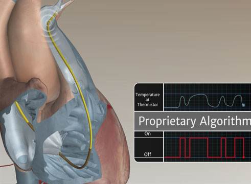 Swan-Ganz™ Catheter Continuous Cardiac Output Animation