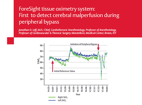 Case study: First to detect malperfusion during peripheral bypass