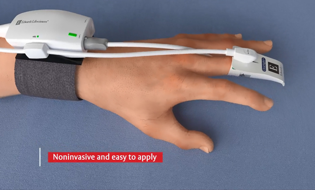 Redesigned ClearSight Finger Cuff Placement