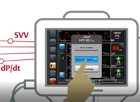 Acumen™ Hypotension Prediction Index Software Animation