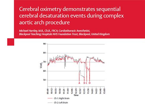 Case study: Sequential desaturation during complex aortic arch