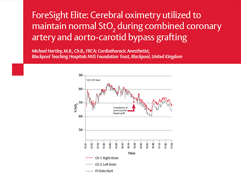 Case study: StO2 during coronary & carotid bypass